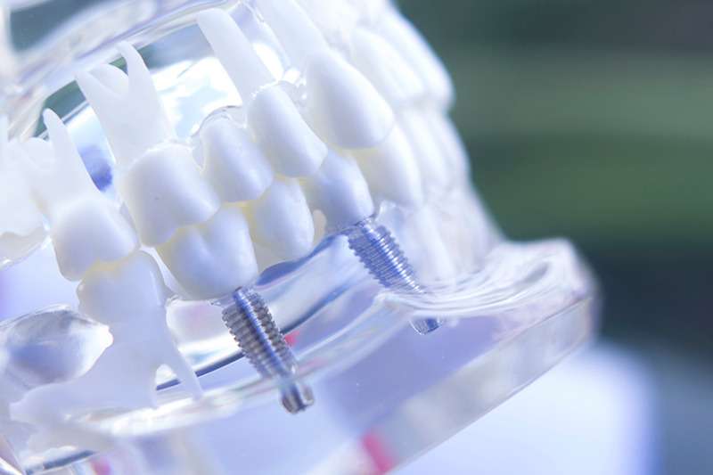 人工歯根を埋め込むインプラント治療