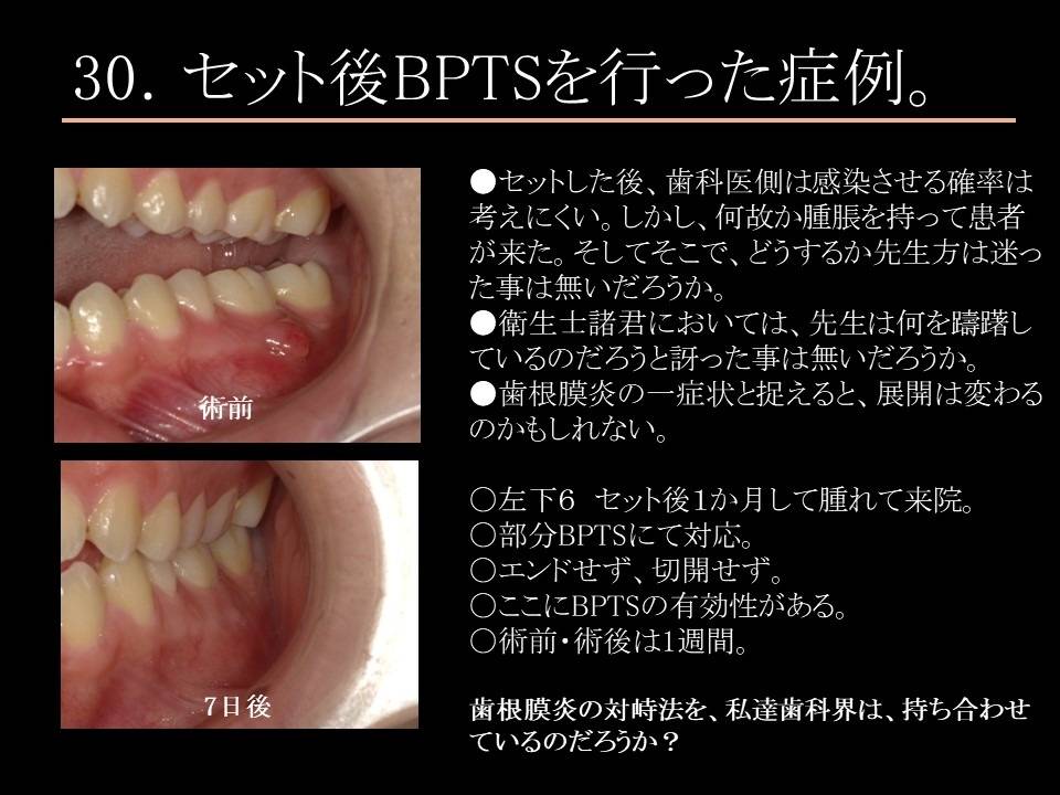歯肉の腫れ　歯根膜炎｜こすが歯科医院