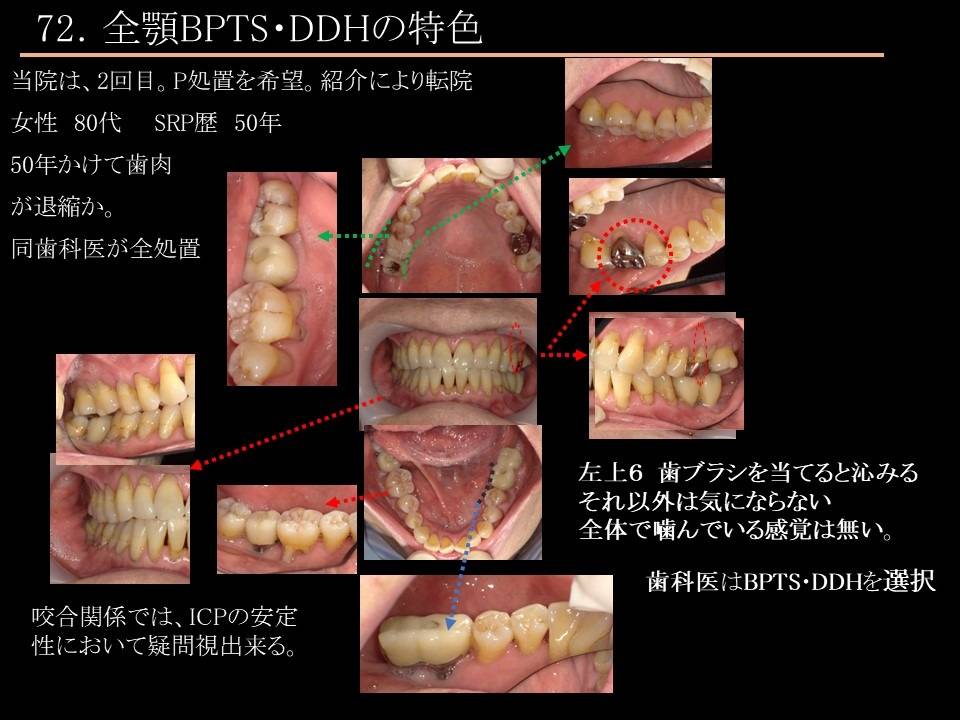 歯周病と歯肉退縮のもう一つの見方｜こすが歯科医院