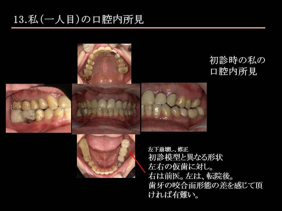 歯の形態は、上手く噛むことを担保されていますか。｜こすが歯科医院